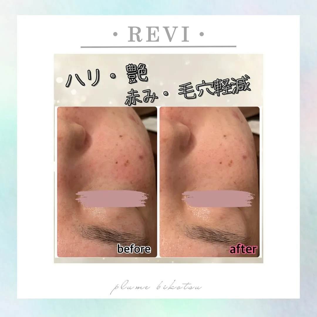 REVIのハーブピーリング🌿試してみませんか？✨✨